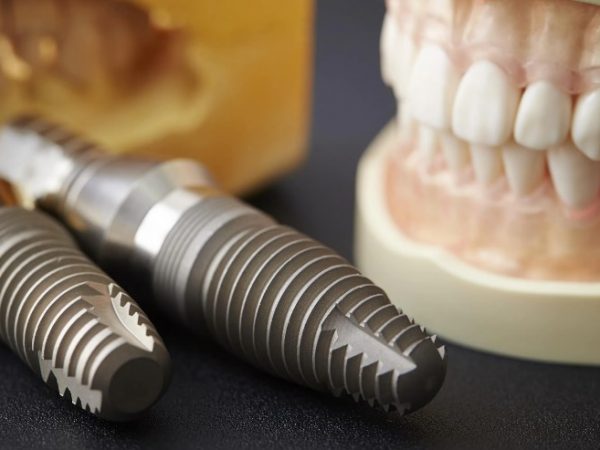 Качественные комплектующие для стоматологических имплантатов: Ключ к долговечности и здоровью